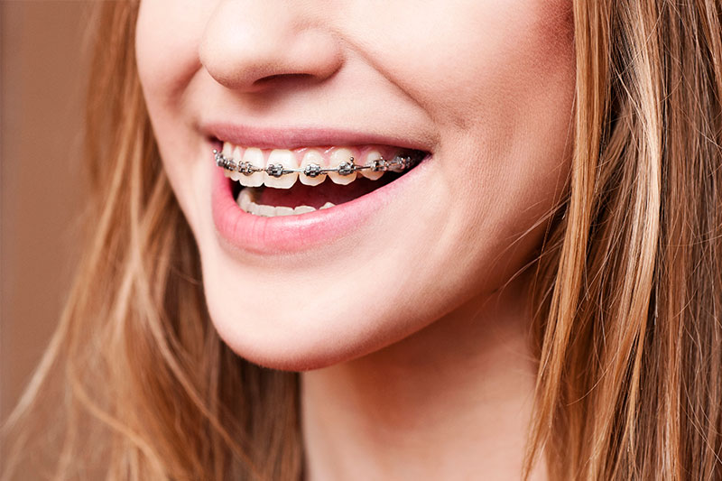 Orthodontics in Glendale